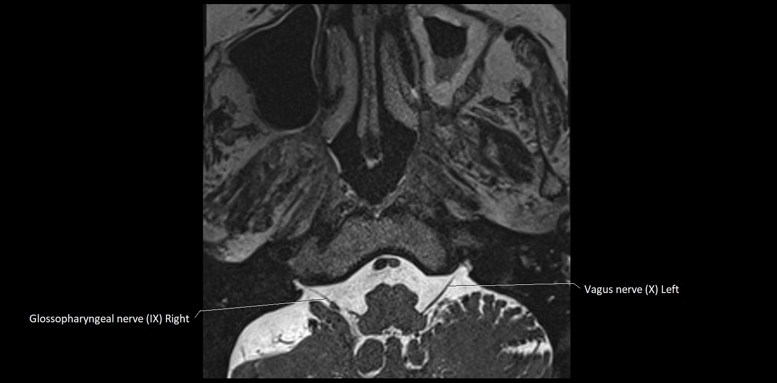 Cranial nerve anatomy axial MRI 3T image 69.webp
